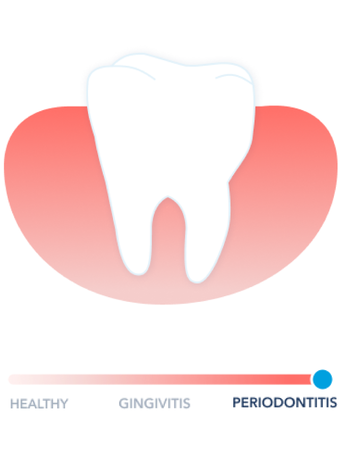 periodontitis